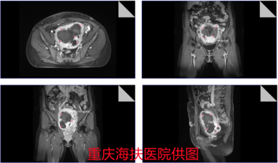 腹腔镜、开腹、再次腹腔镜&hellip;&hellip;她的保宫之路如何走下去？