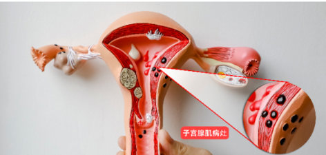 子宫腺肌病的危害与治疗：聚焦生育保护与高强度超声治疗新选择