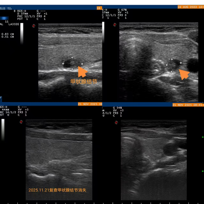 发现甲状腺结节，不开刀也能治疗
