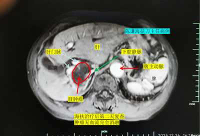 74岁晚期肝癌患者千里求医，海扶刀精准消融特殊部位肿瘤